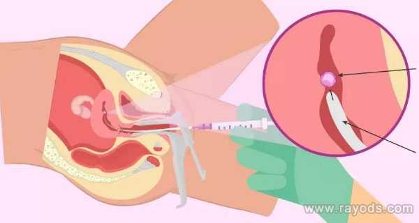 哈尔滨人工代孕的方法都有哪些_专家解读：去泰国做试管婴儿移植单胎还是多
